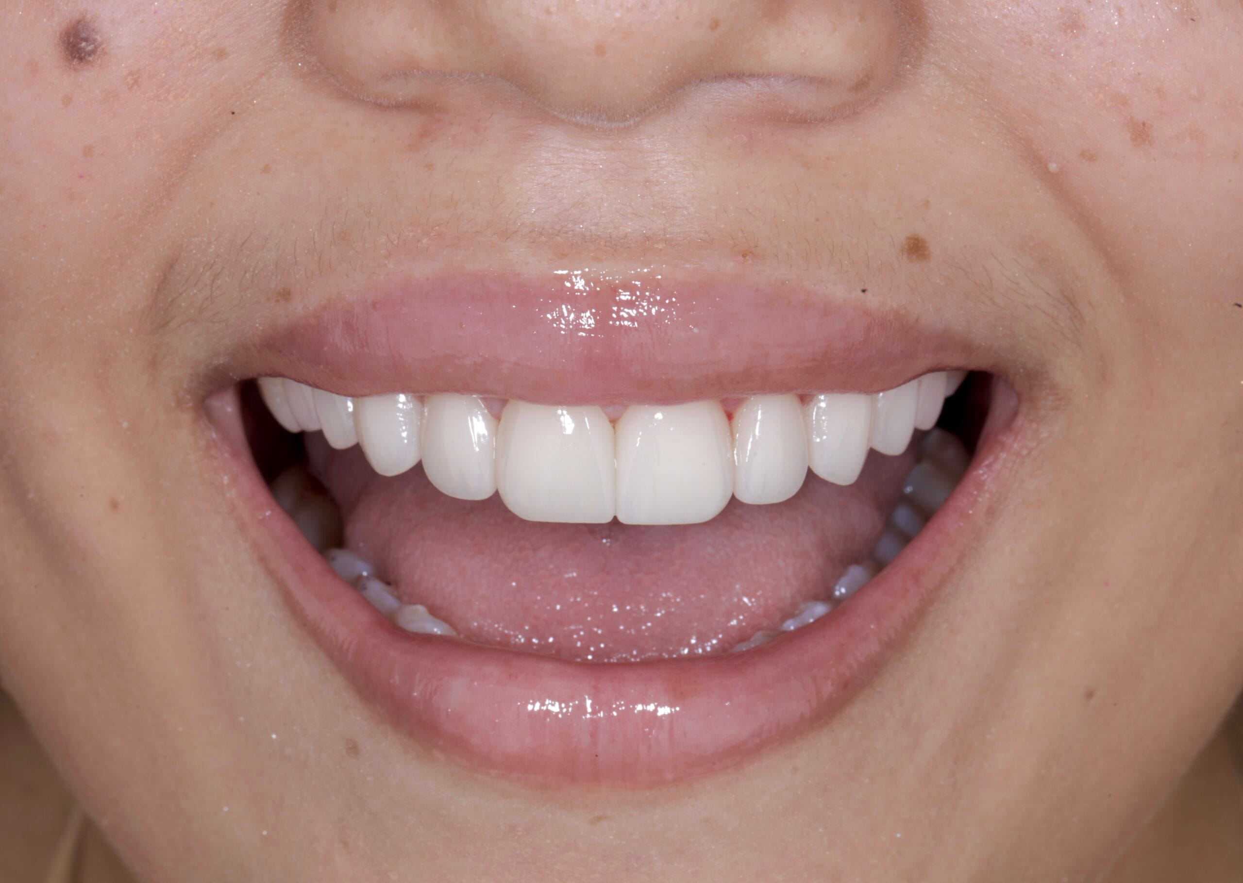 Ceramic Veneers in Colombia: Why they change everything?