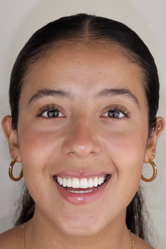 Smile design with veneers and implant