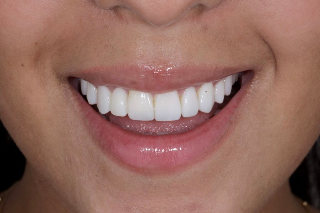 Smile design with veneers and implant