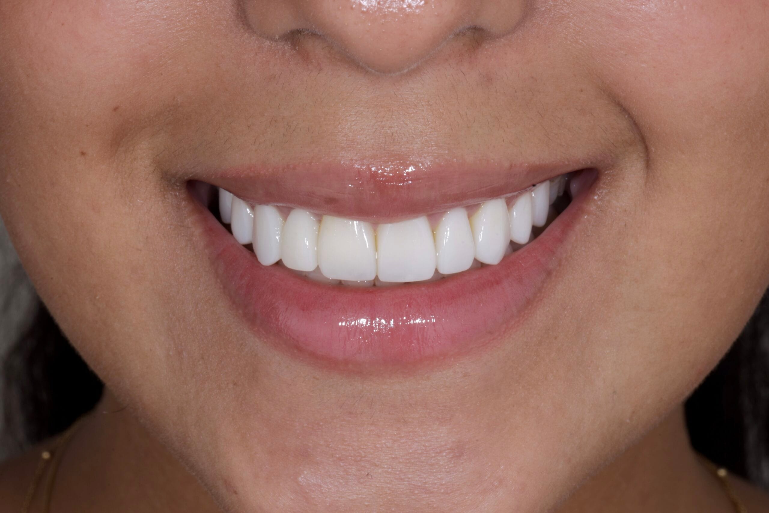 Smile Design with Veneers and Implant: A Solution After Orthodontics