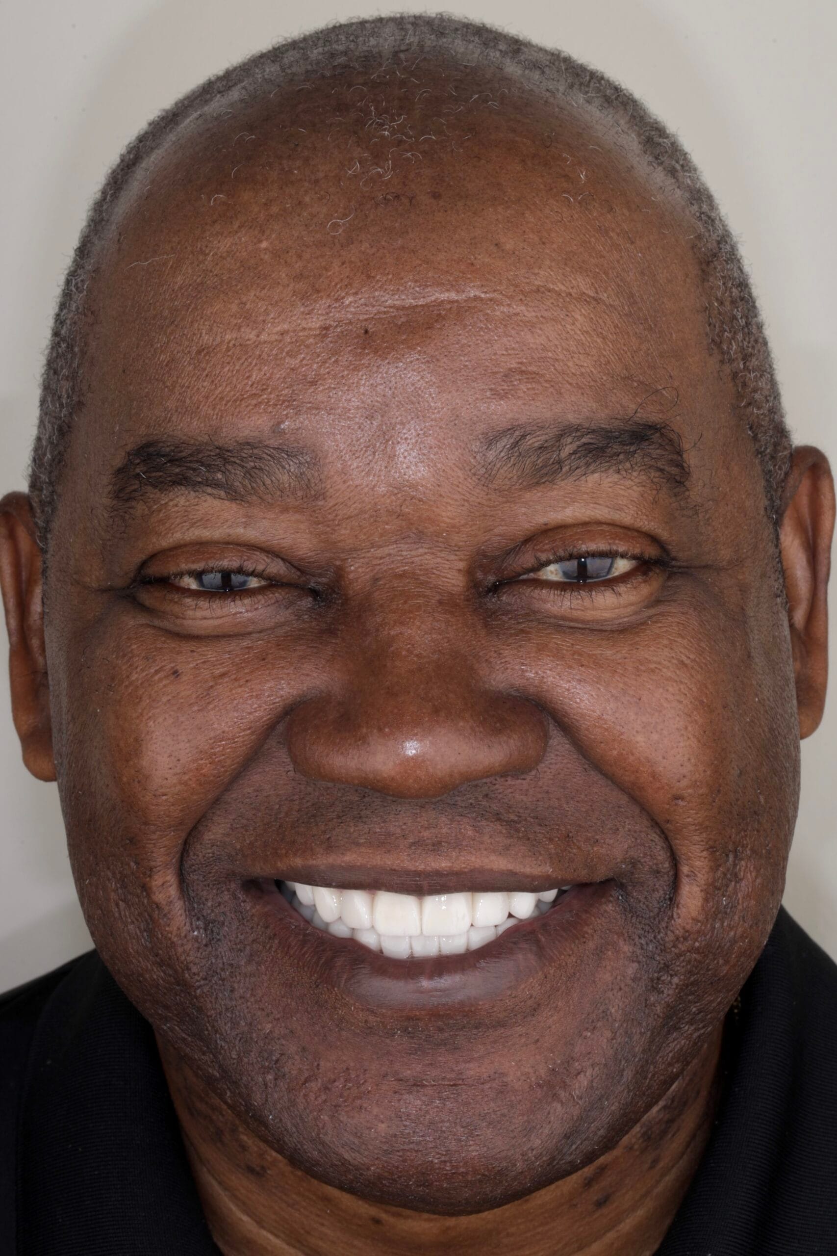 Full mouth ceramic rehabilitation