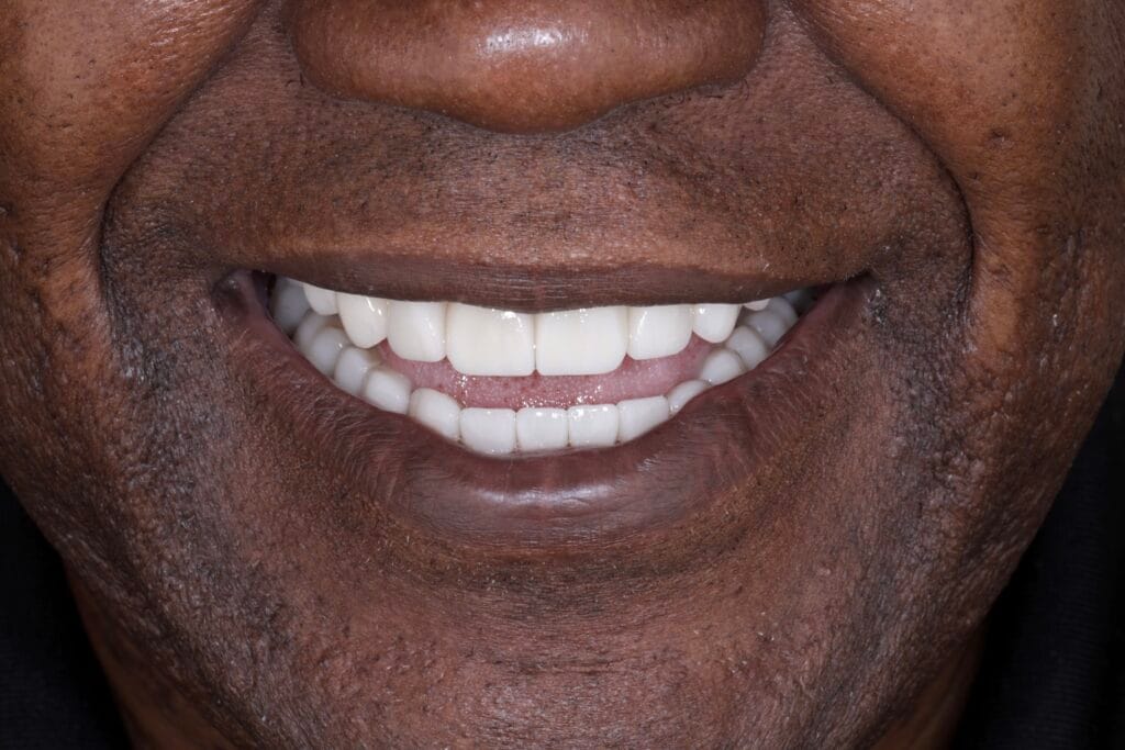 Full mouth ceramic rehabilitation