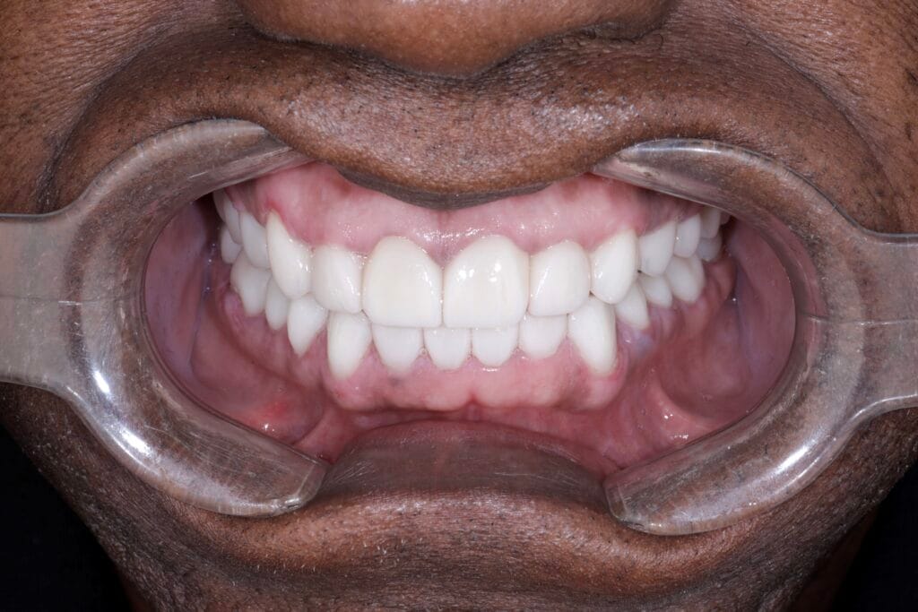 Full mouth ceramic rehabilitation