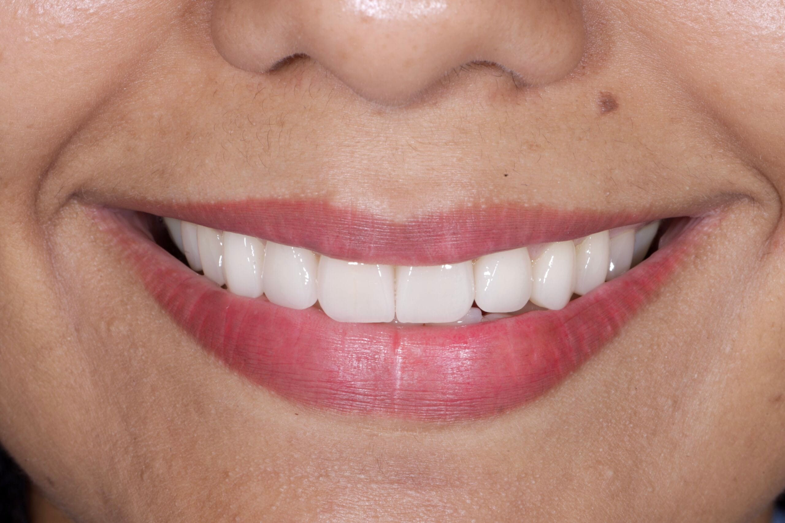 Ceramic Veneers Smile for a Natural and Harmonious Smile