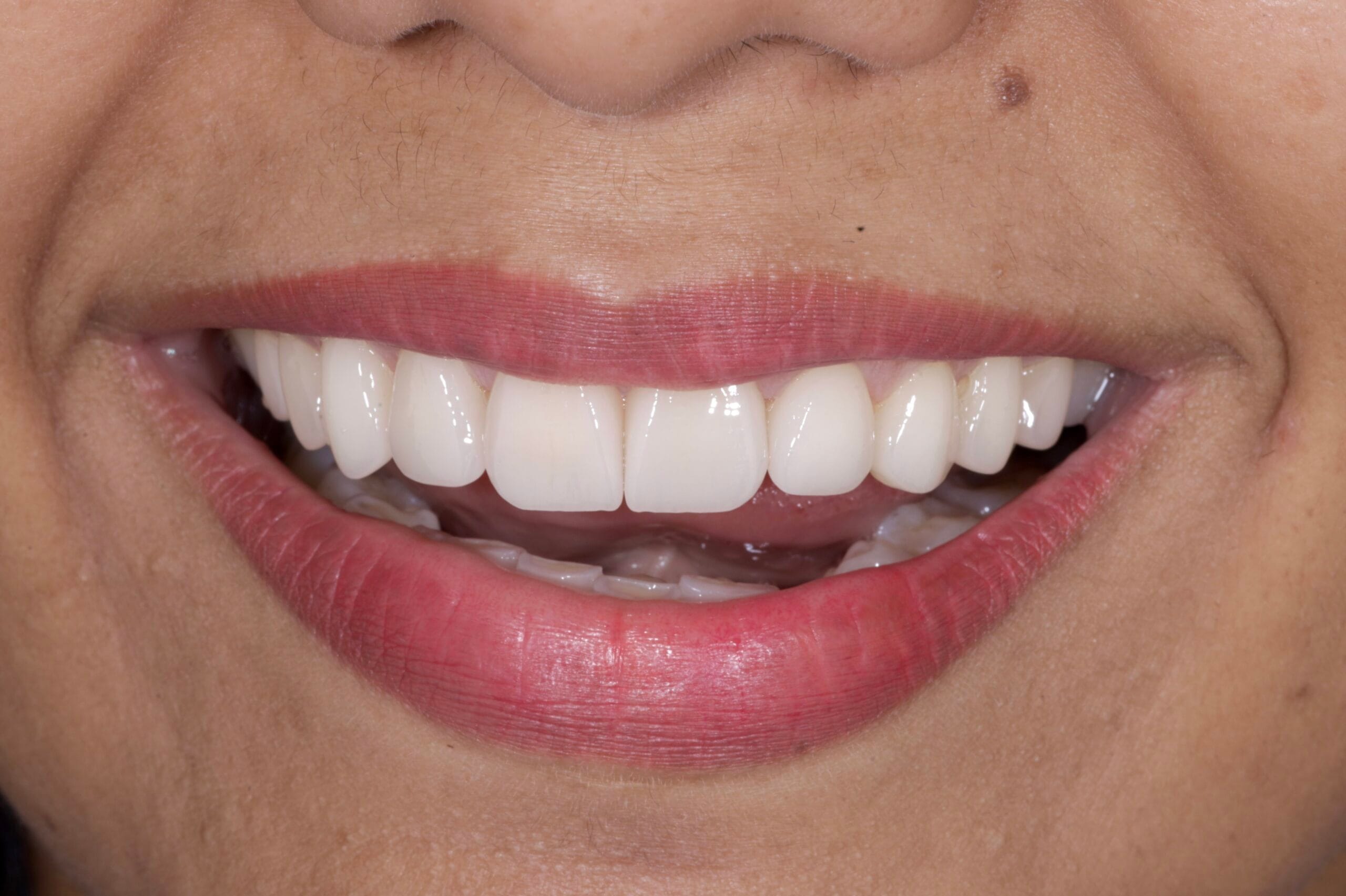 Ceramic veneers smile transformation