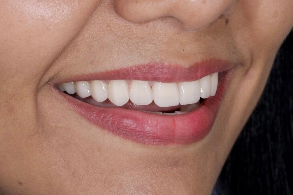 Ceramic veneers smile transformation
