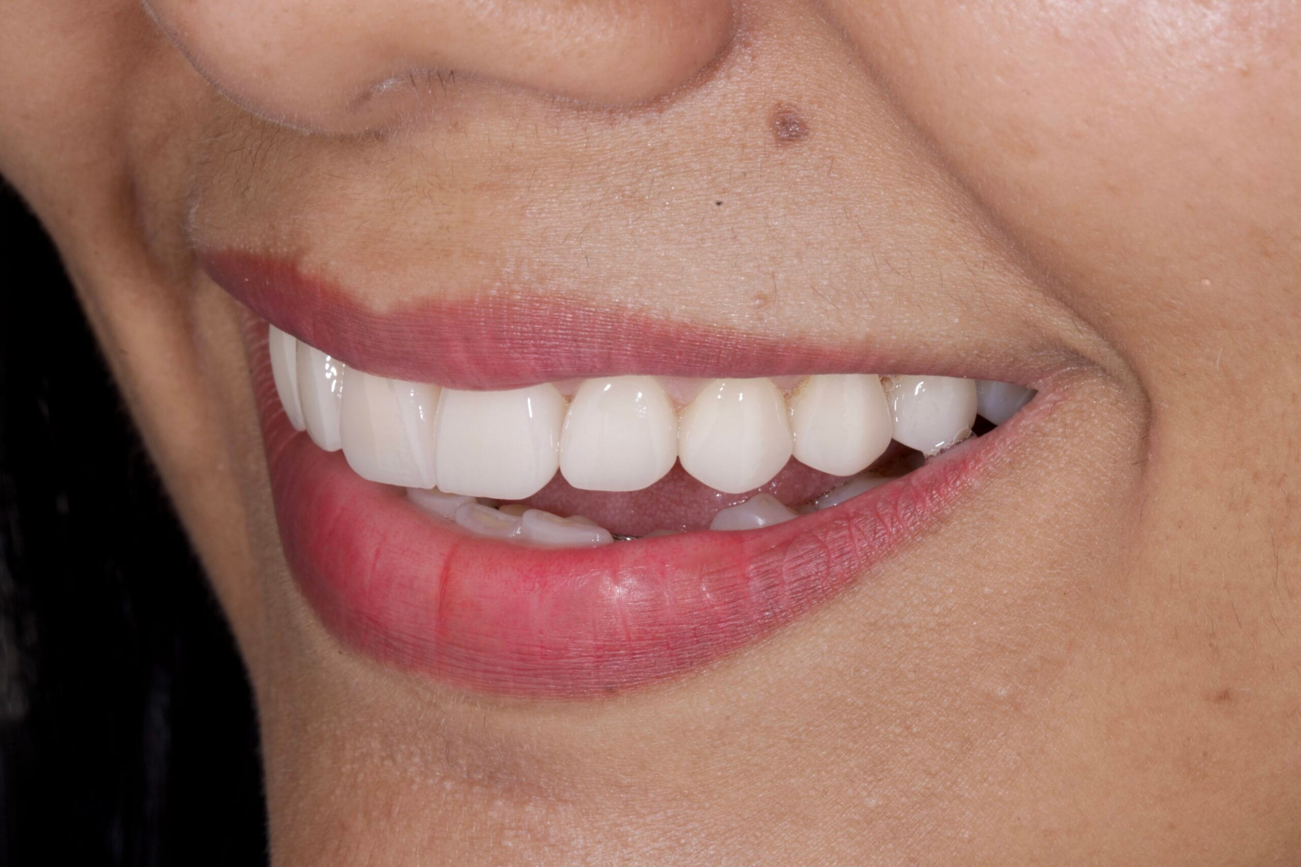 Ceramic veneers smile transformation