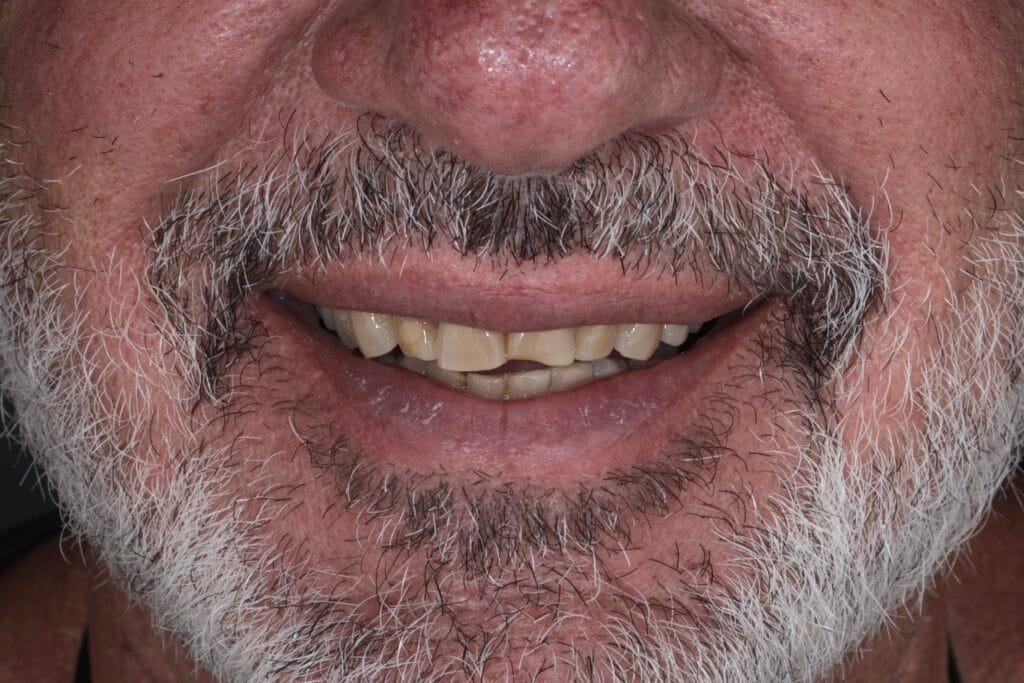 Smile makeover for worn teeth
