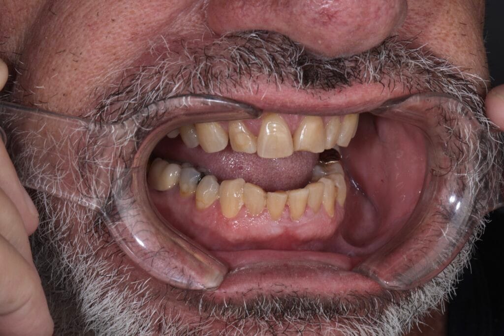 Smile makeover for worn teeth