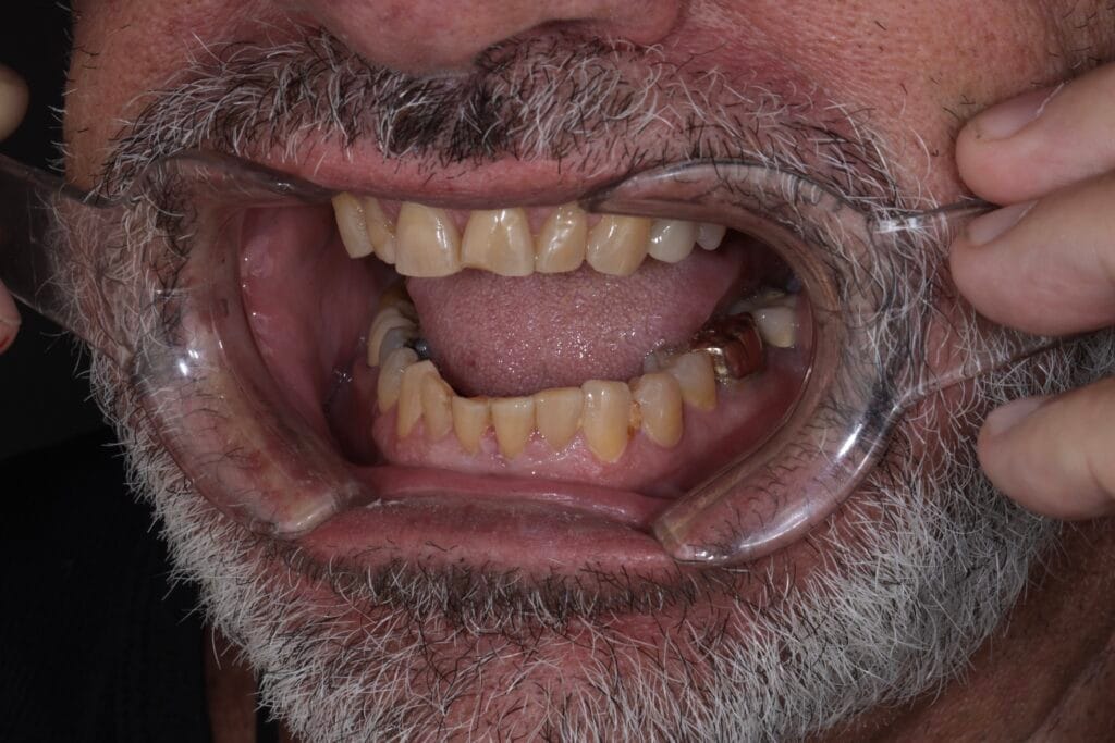 Smile makeover for worn teeth