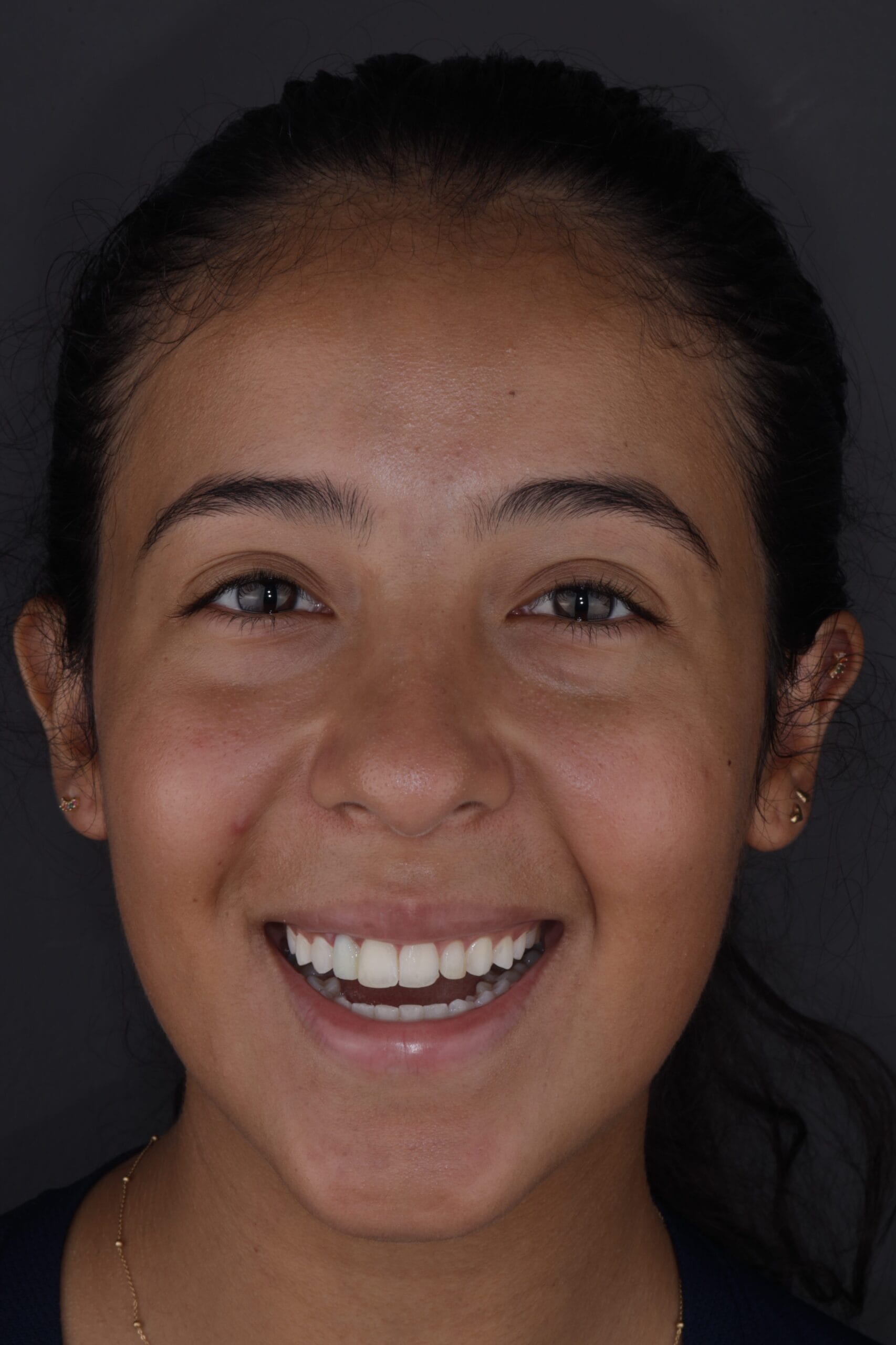 Smile design with veneers and implant