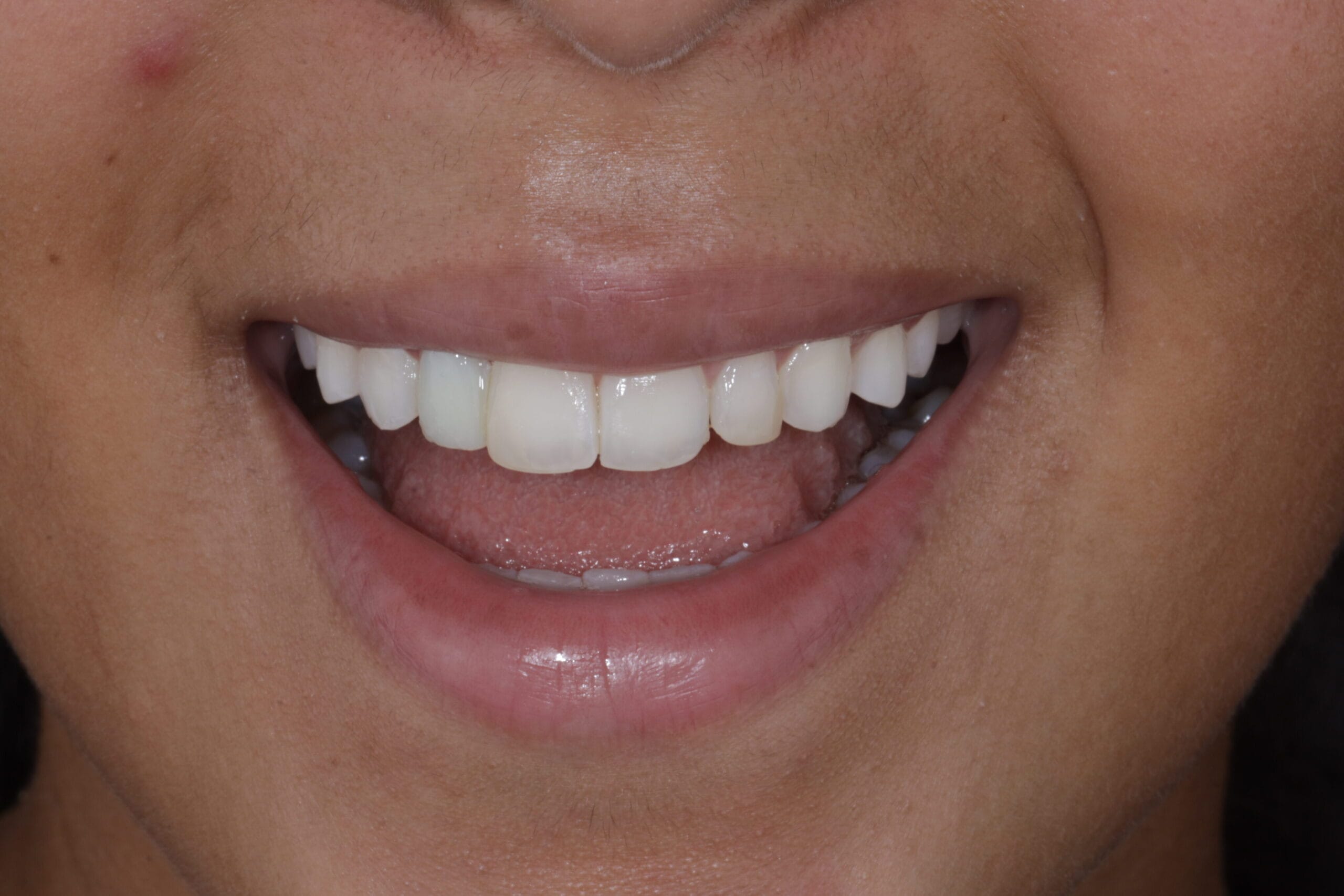 Smile design with veneers and implant