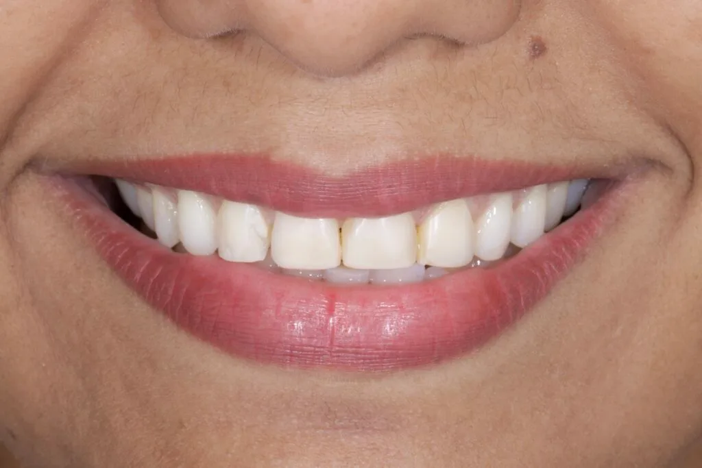 Ceramic Veneers Smile for a Natural and Harmonious Smile