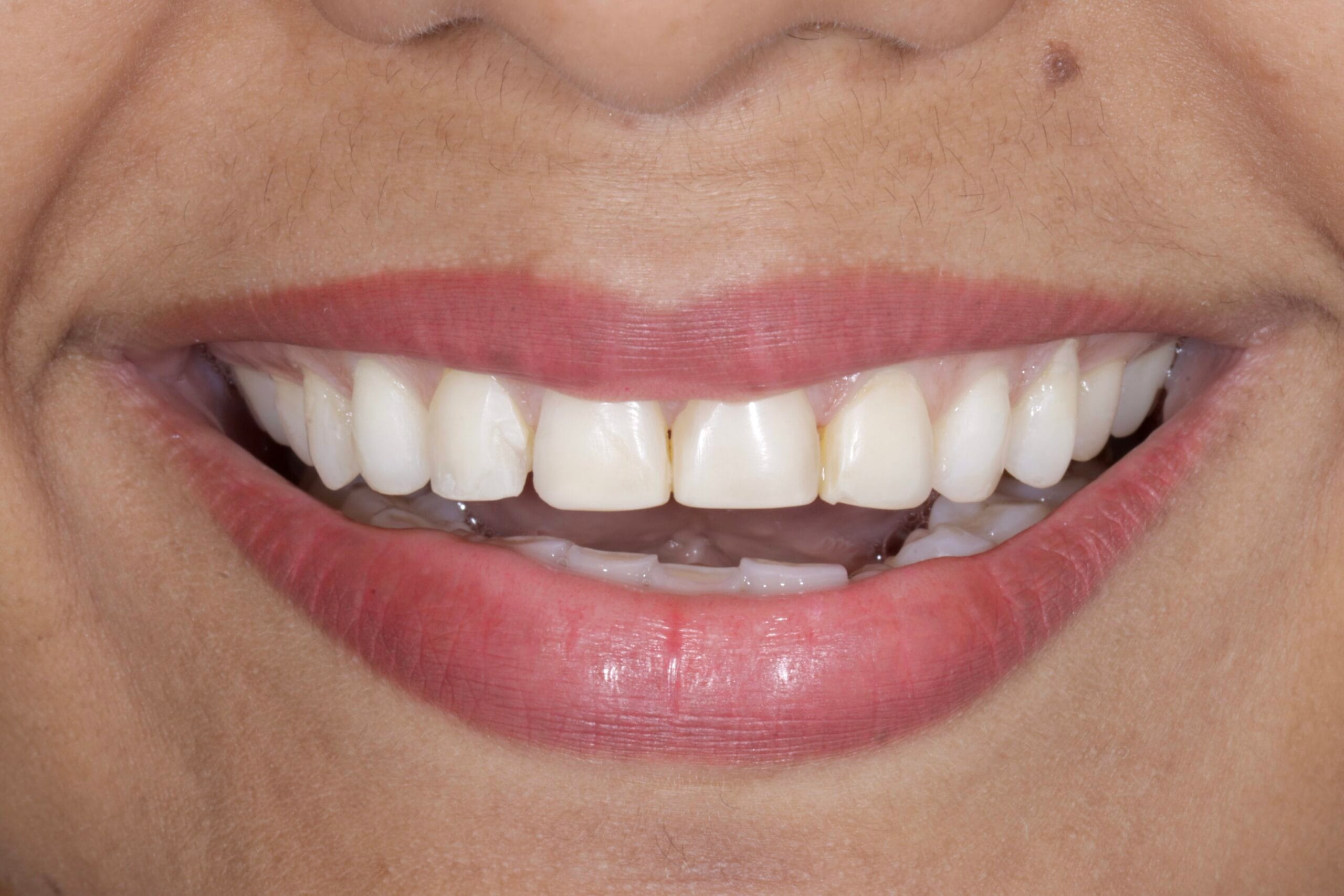 Ceramic veneers smile transformation