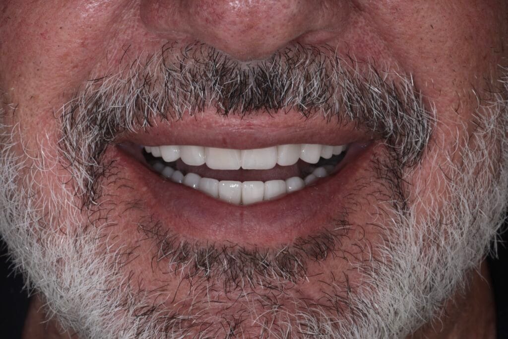 Smile makeover for worn teeth