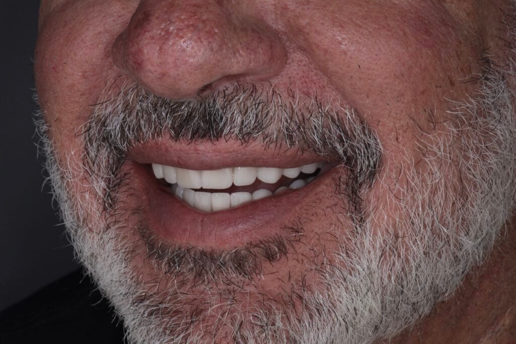 Smile makeover for worn teeth