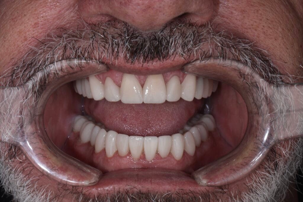 Smile makeover for worn teeth