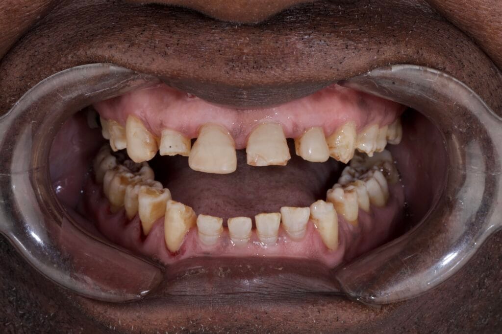 Full mouth ceramic rehabilitation