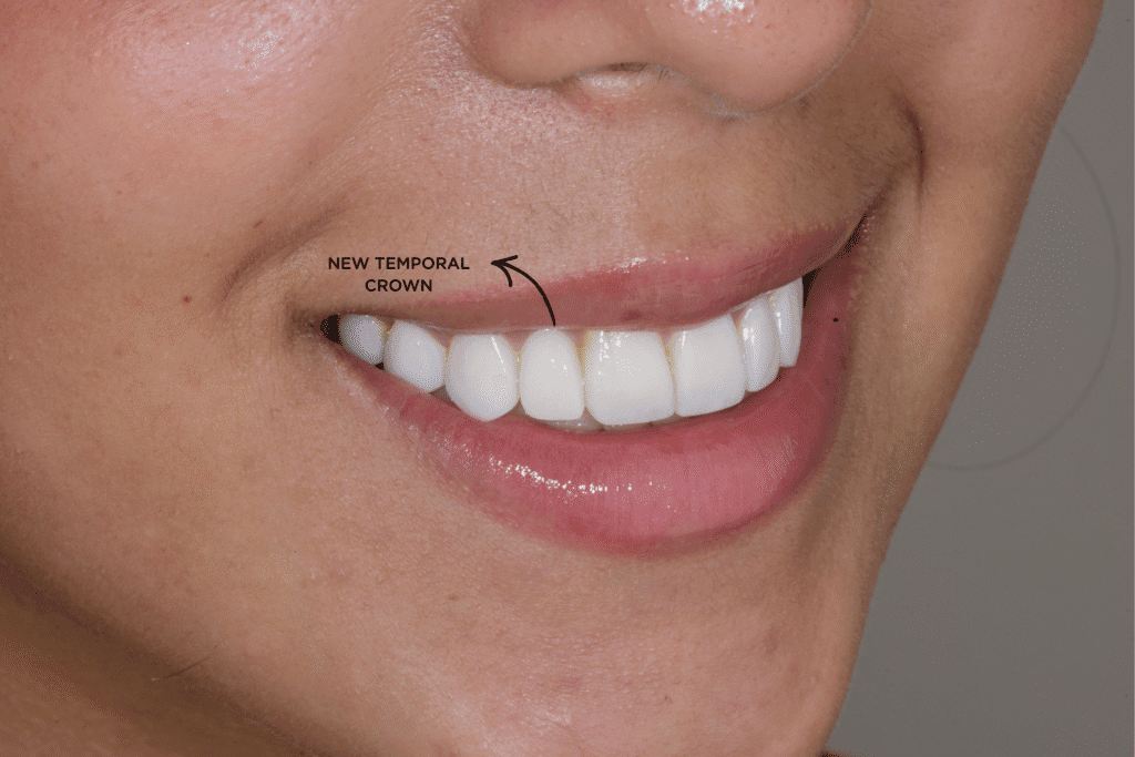 Smile design with veneers and implant
