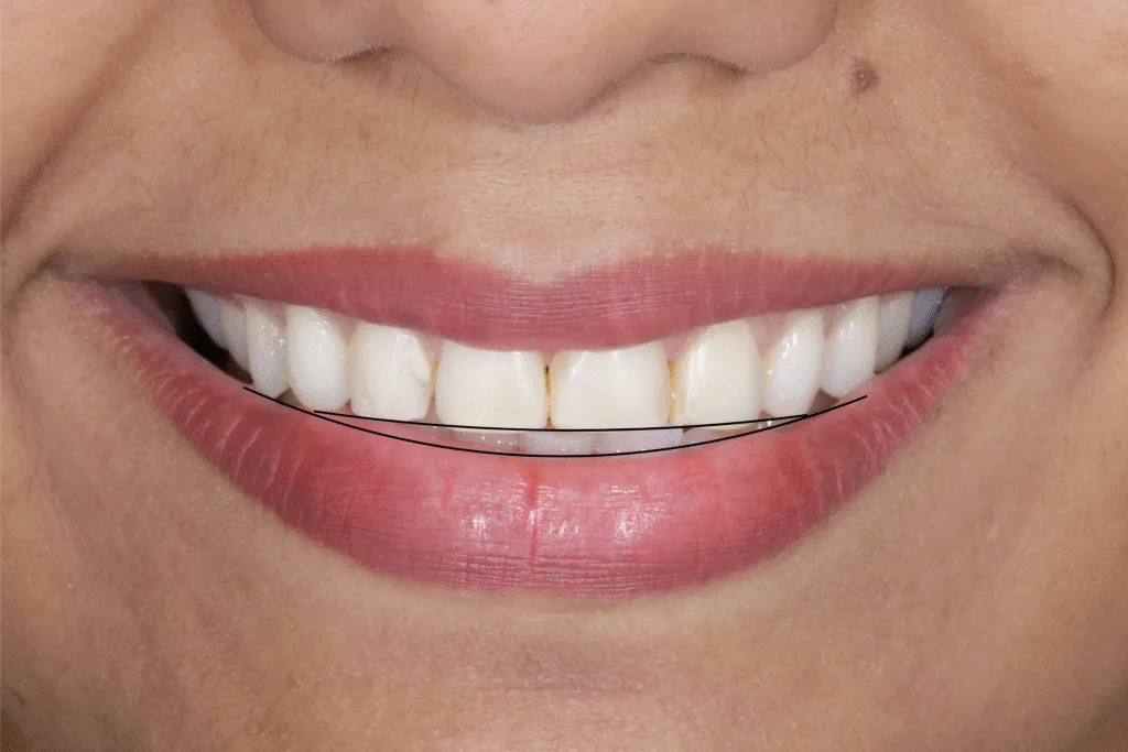 SMILE Ceramic Veneers Smile for a Natural and Harmonious Smile