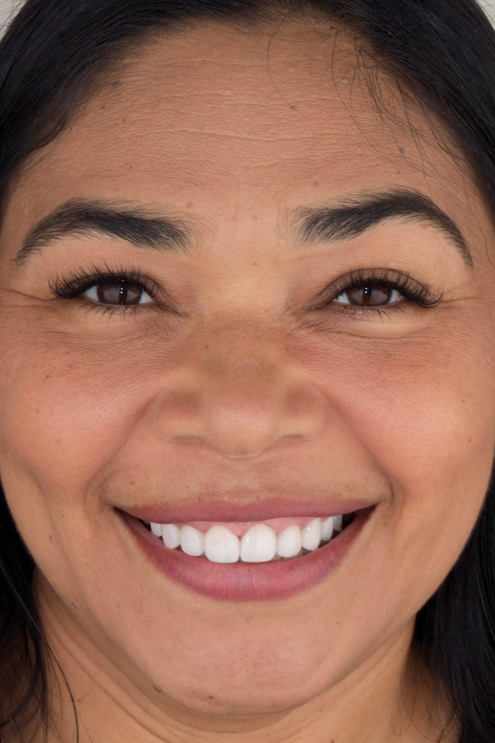 Deep bite smile makeover