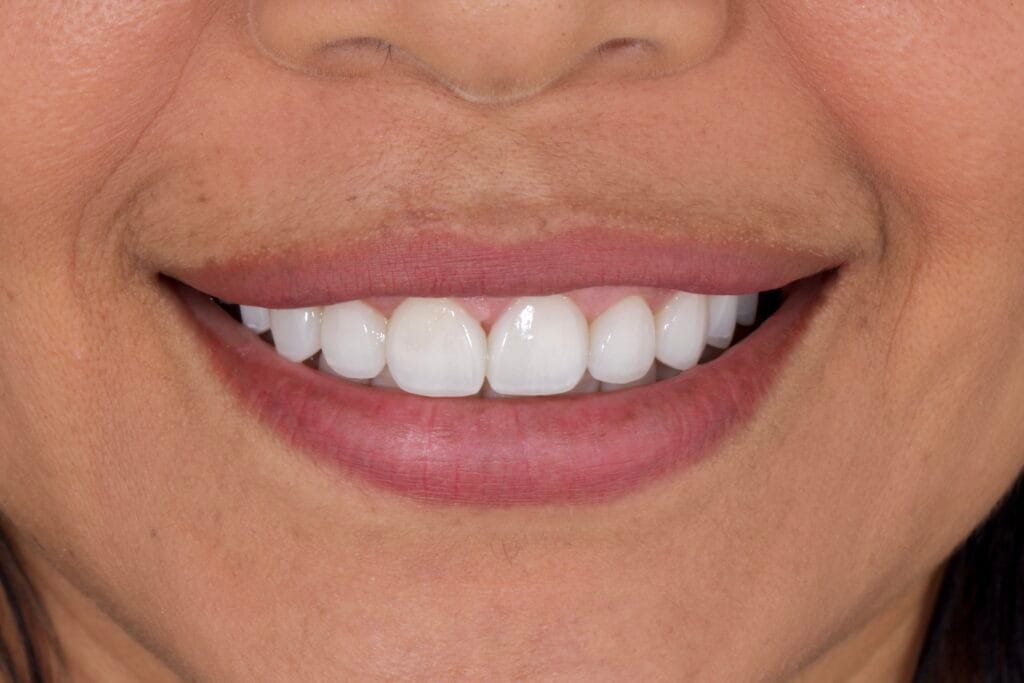 Deep bite smile makeover
