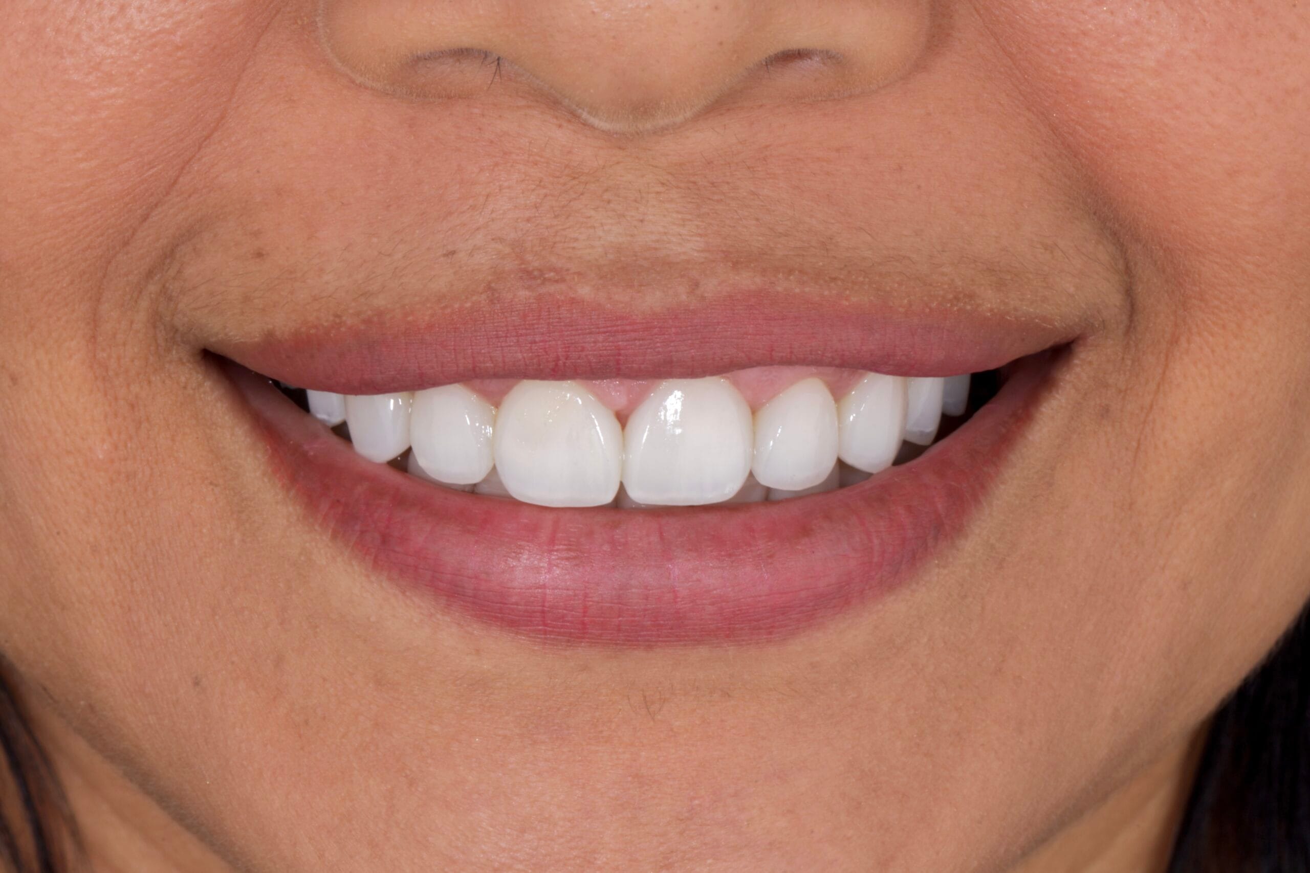 Deep Bite Smile Makeover: When Aesthetics Fail Because Function Was Ignored