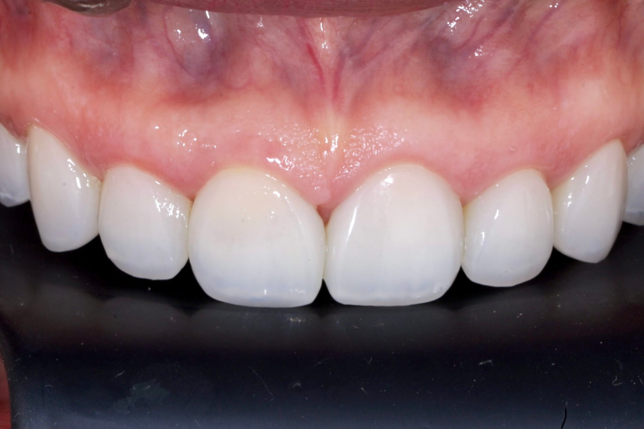 Deep bite smile makeover