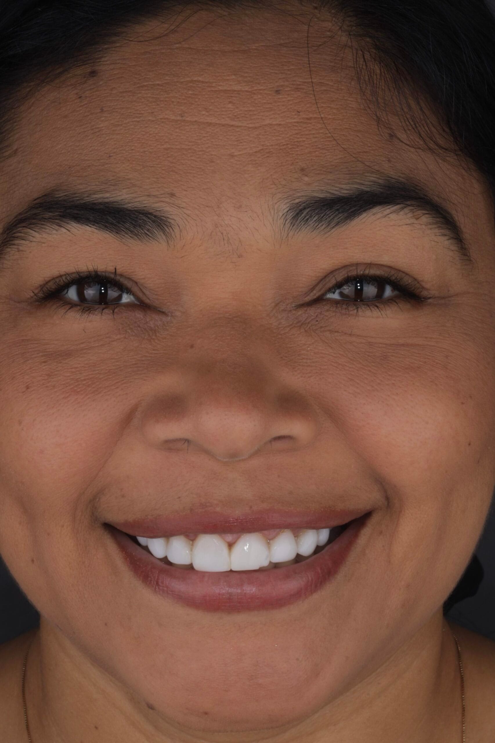 Deep bite smile makeover