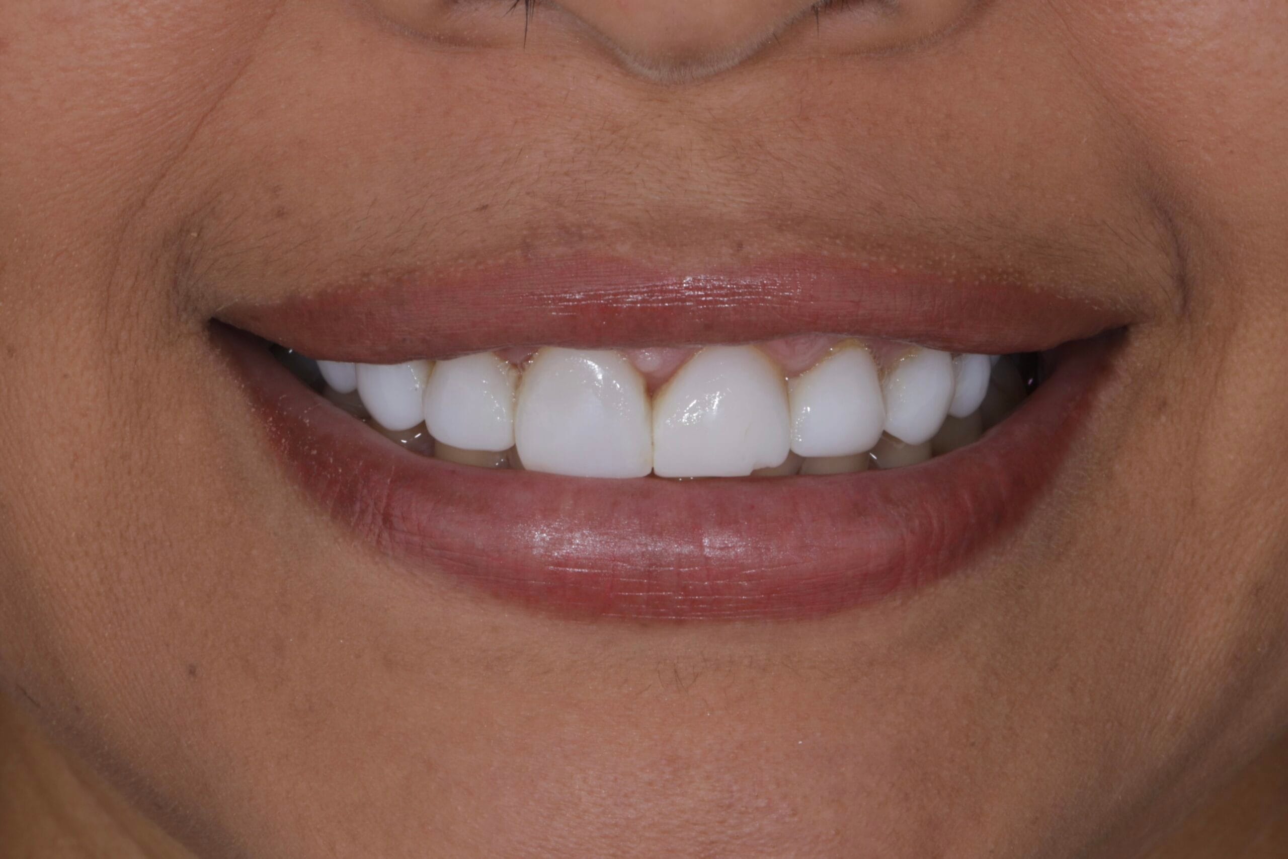 Deep bite smile makeover