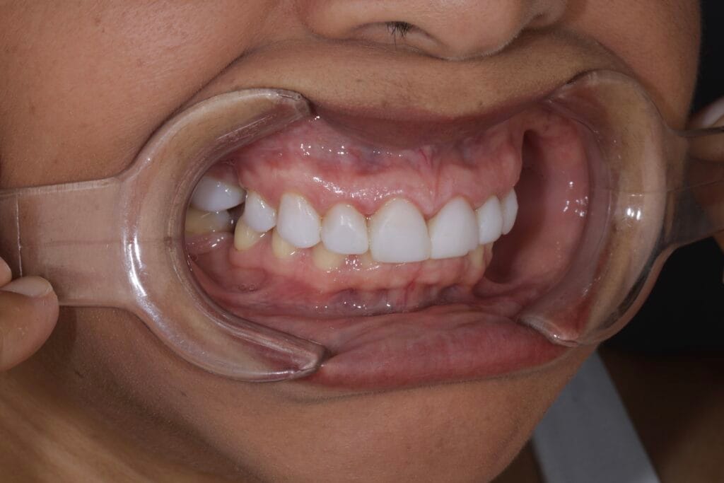 Deep bite smile makeover