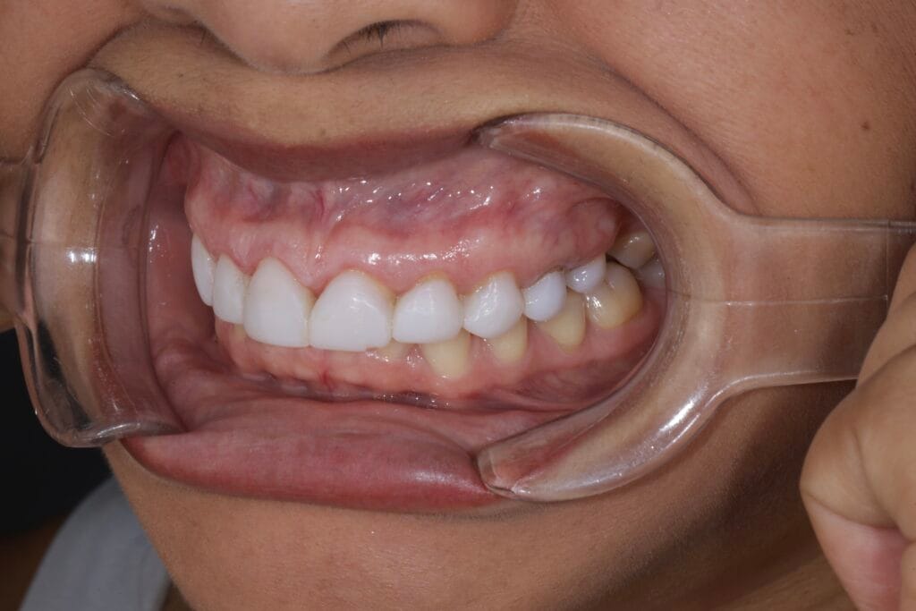 Deep bite smile makeover