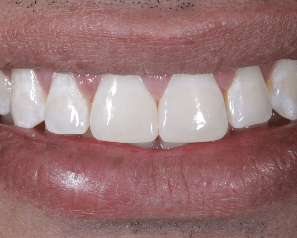 edge bonding for diastema closure