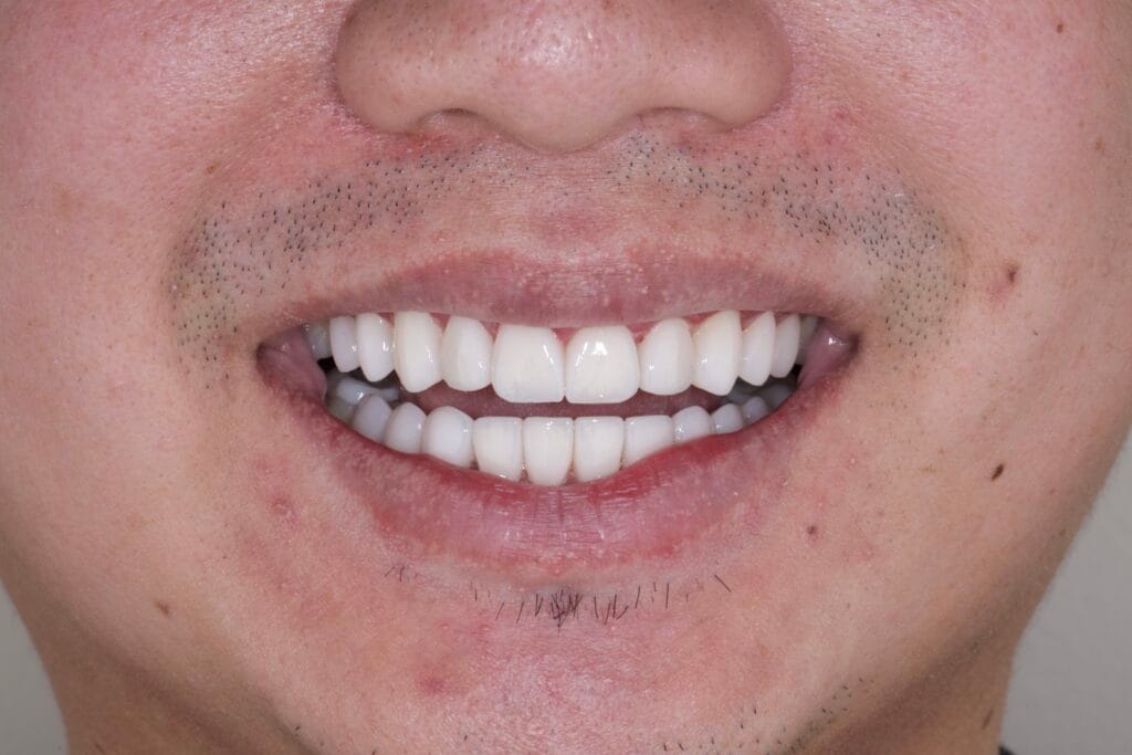 Porcelain Veneers in Colombia