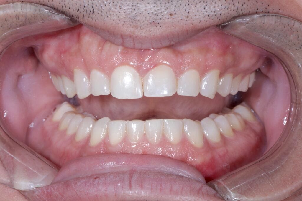 Smile makeover in Colombia