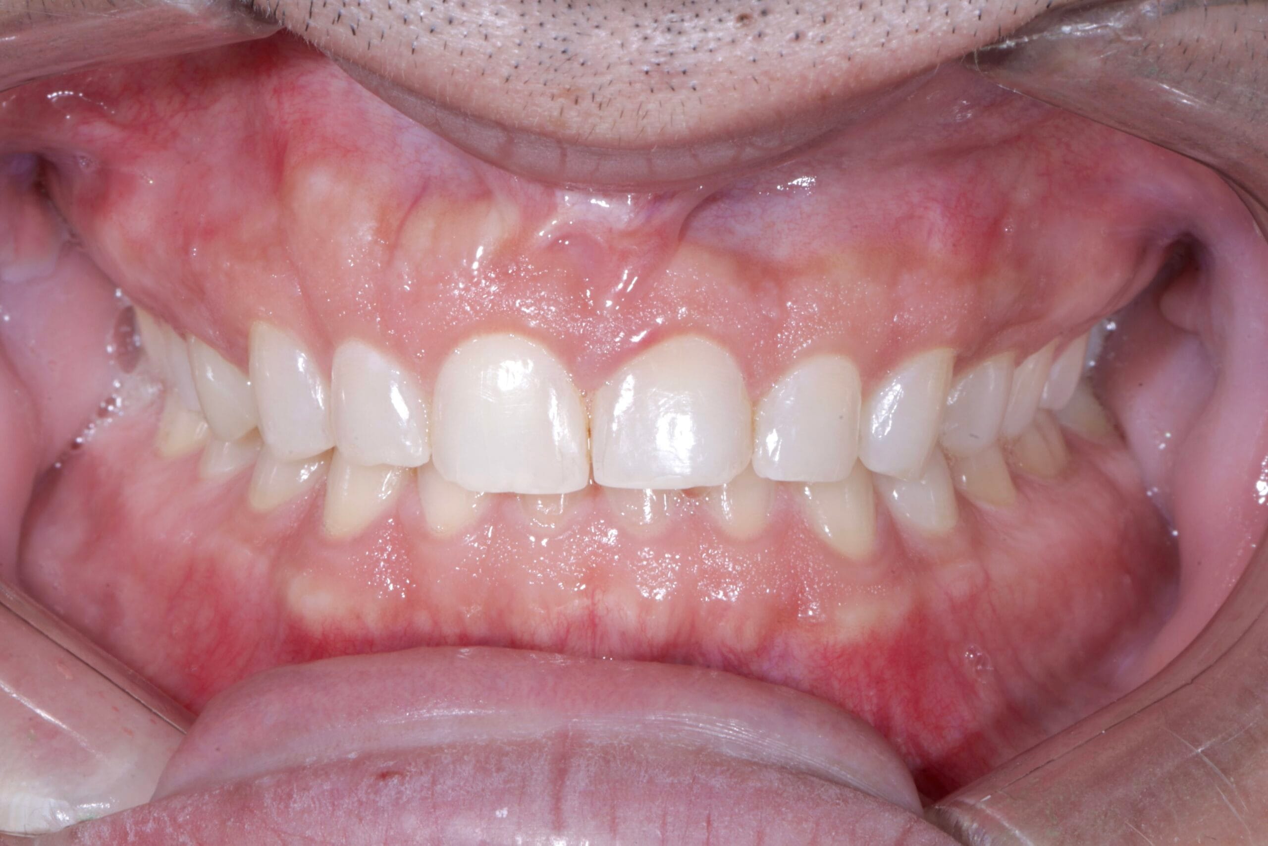 Smile makeover in Colombia