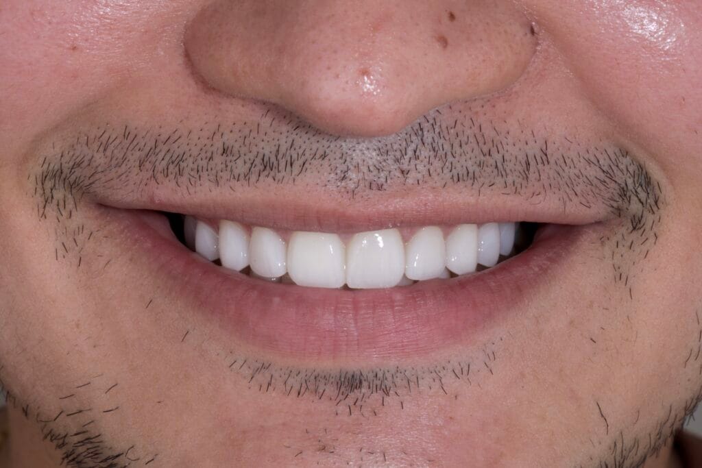 Smile makeover in Colombia