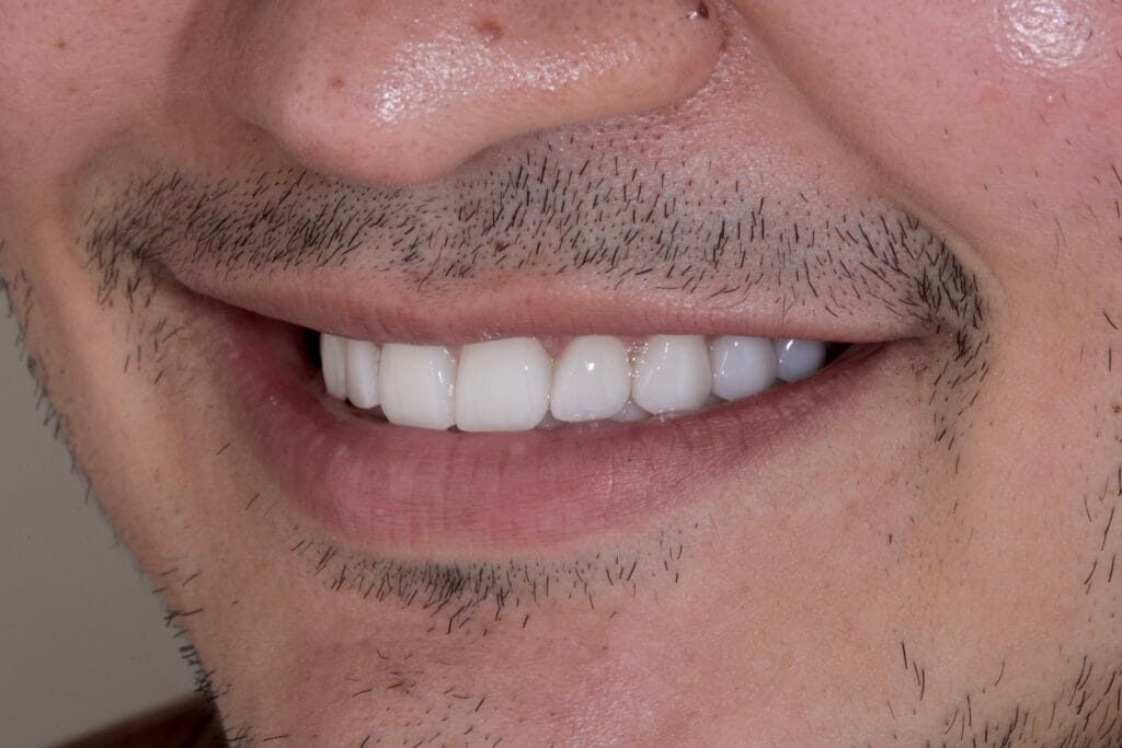 Smile makeover in Colombia