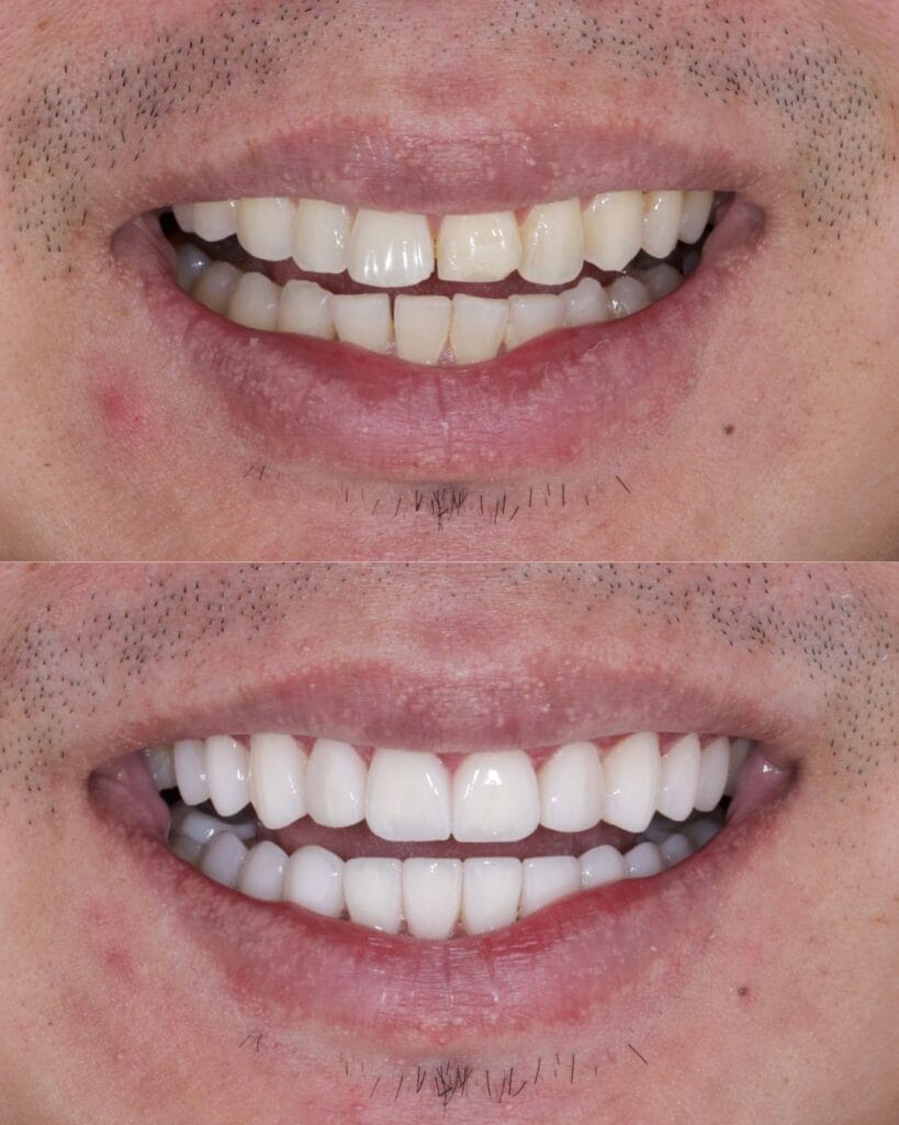 Porcelain Veneers in Colombia