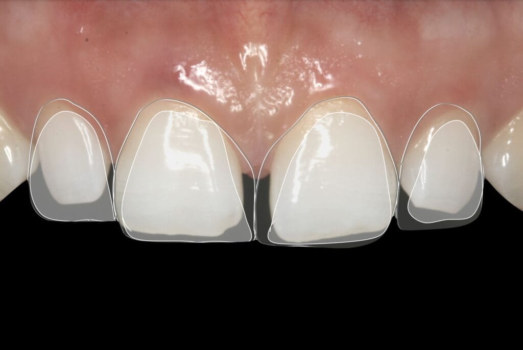 edge bonding for diastema closure
